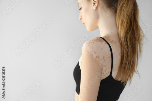 Side view of gorgeous slender young European woman with long ponytail looking down, showing white vitiligo spots on her back and arm. People, dermatology, beauty, depigmentation and skin disorder photo
