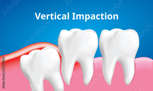 Wisdom tooth ( Vertical impaction ) with inflammation affect , Dental care concept, Realistic illustration Vector