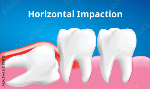 Wisdom tooth ( Horizontal impaction ) with inflammation affect , Dental care concept, Realistic illustration Vector