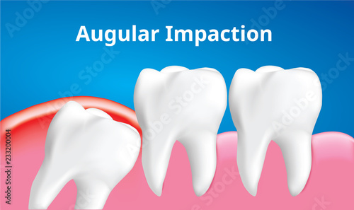Wisdom tooth ( Angular or mesial impaction ) with inflammation affect , Dental care concept, Realistic illustration Vector