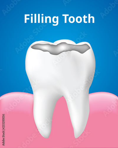 Tooth Filling with gum Dental care concept, Realistic design illustration Vector.