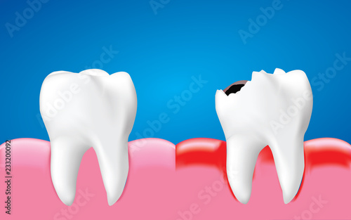 Decay tooth with inflammation and healthy tooth, Dental care concept, Realistic illustration Vector.