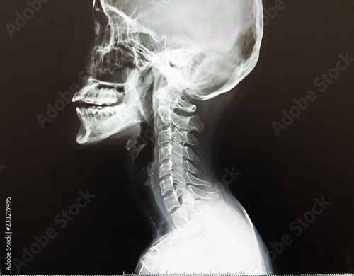 Normal cervical spine of a girl, X-ray Cervical spine after had an adcident.