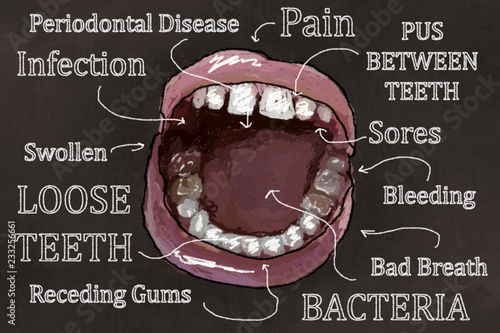 Symptoms of Gum Disease Illustration photo