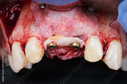 Obraz na plátně complex membrane implantation and soft tissue to build up the patient's gums