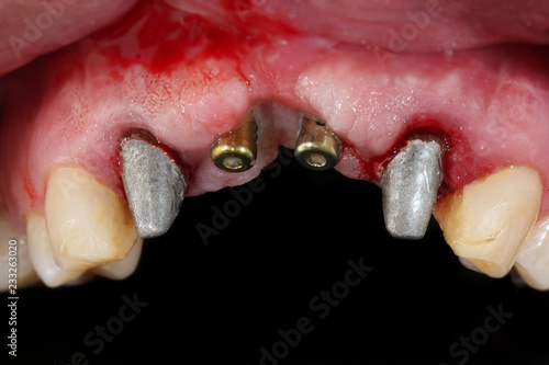 implanting and abutments of the front incisors