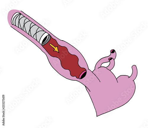 Stent Heart Attack Clogged Artery