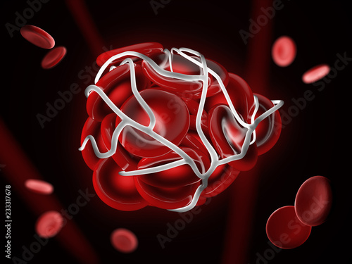 Fotografía 3d Illustration of illustration of a blood clot, thrombus or embolus with coagul