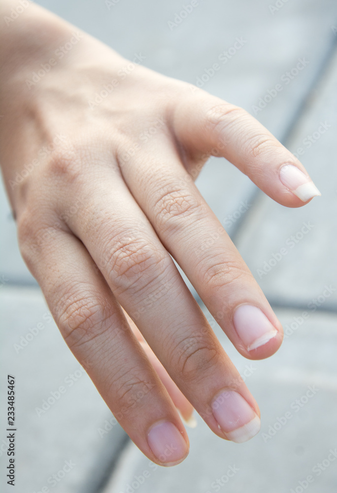 Image of a broken nail hand Image of a broken nail hand