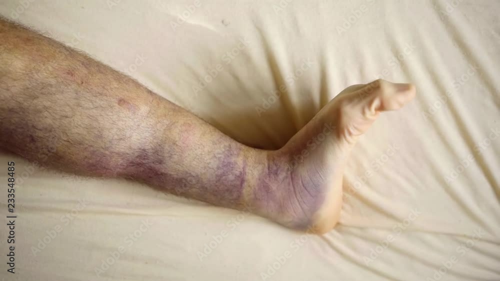 Man's leg covered in big bruises. Man's leg covered in big bruises.