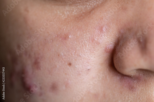 Backgrounds of lesions skin caused  by acne on the face in the clinic.