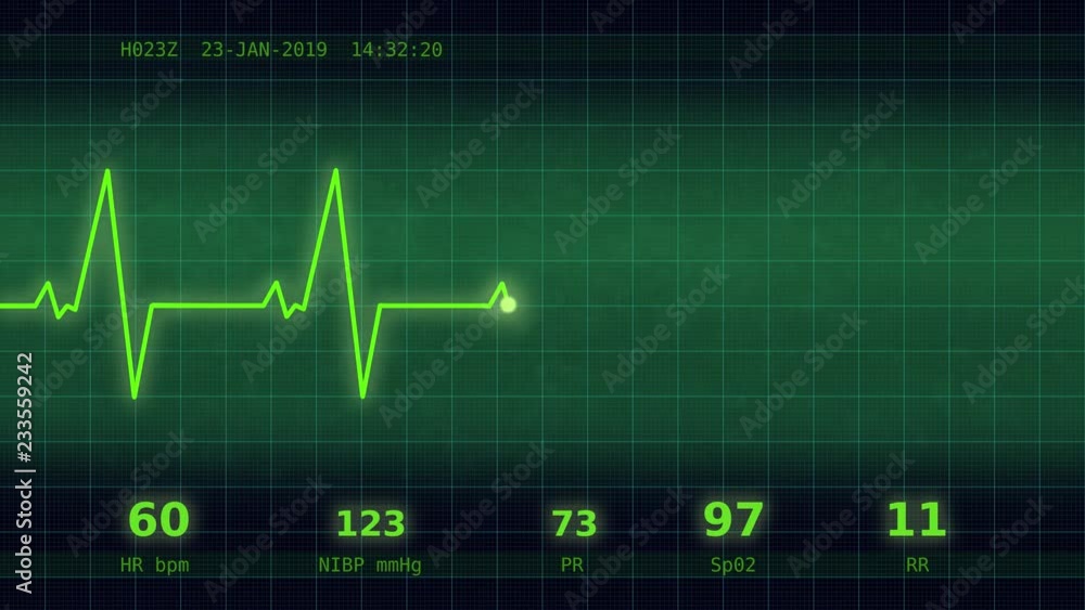 The graph of normal heartbeat with additional parameters: heart rate, rhythm, period on the green monitor viewed straight ahead The graph of normal heartbeat with additional parameters: heart rate, rhythm, period on the green monitor viewed straight ahead