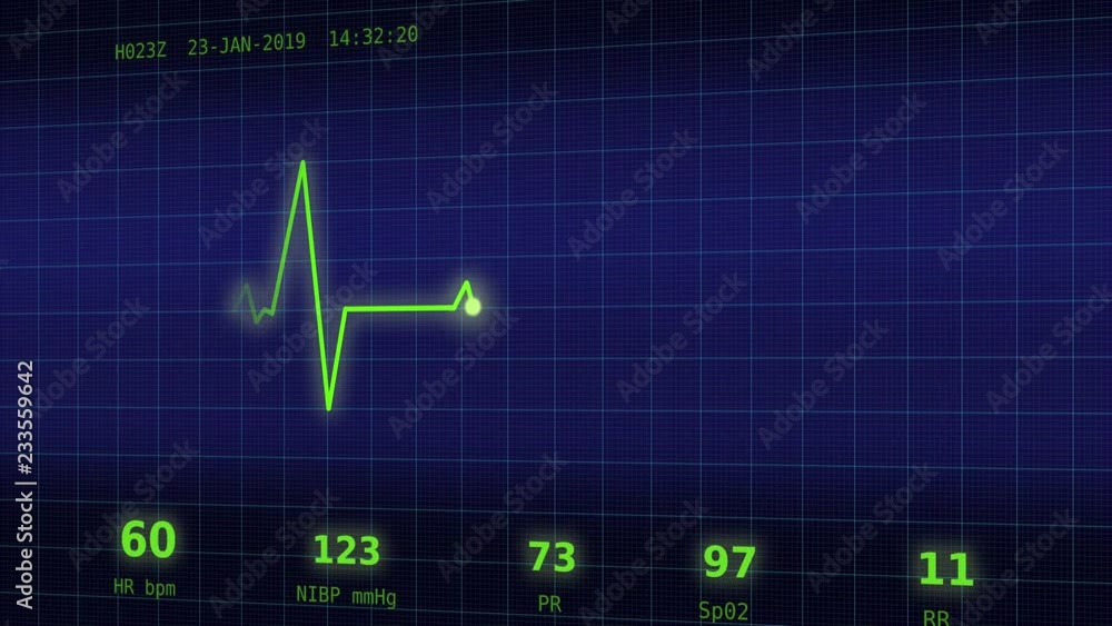 The graph of normal heartbeat with additional parameters: heart rate, rhythm, period on the blue monitor viewed slightly from the side The graph of normal heartbeat with additional parameters: heart rate, rhythm, period on the blue monitor viewed slightly from the side