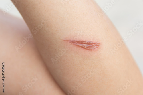 Hot wound  Arm scald  Wounds caused by scalding hot water