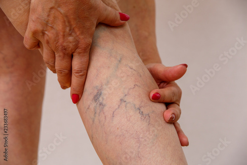 An elderly woman in white panties is touching her legs with cellulite and varicose veins on a light isolated background. Concept for medicine and cosmetology.