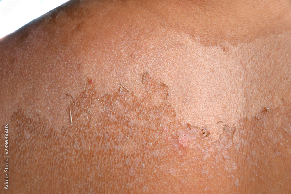 Fototapeta premium Small detail of a sunburned peeling