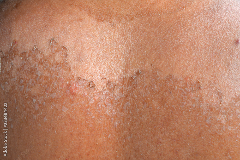 Fototapeta premium Small detail of a sunburned peeling