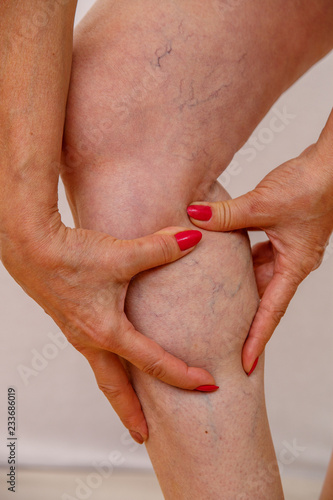 Elderly woman in underwear shows closeup on varicose veins on her legs. Photo on a light isolated background. Concept for medicine and cosmetology.