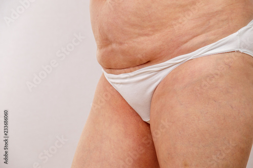 An elderly woman in white panties shows places on the body with cellulite and varicose veins on a bright isolated background. A concept for medicine and cosmetology.