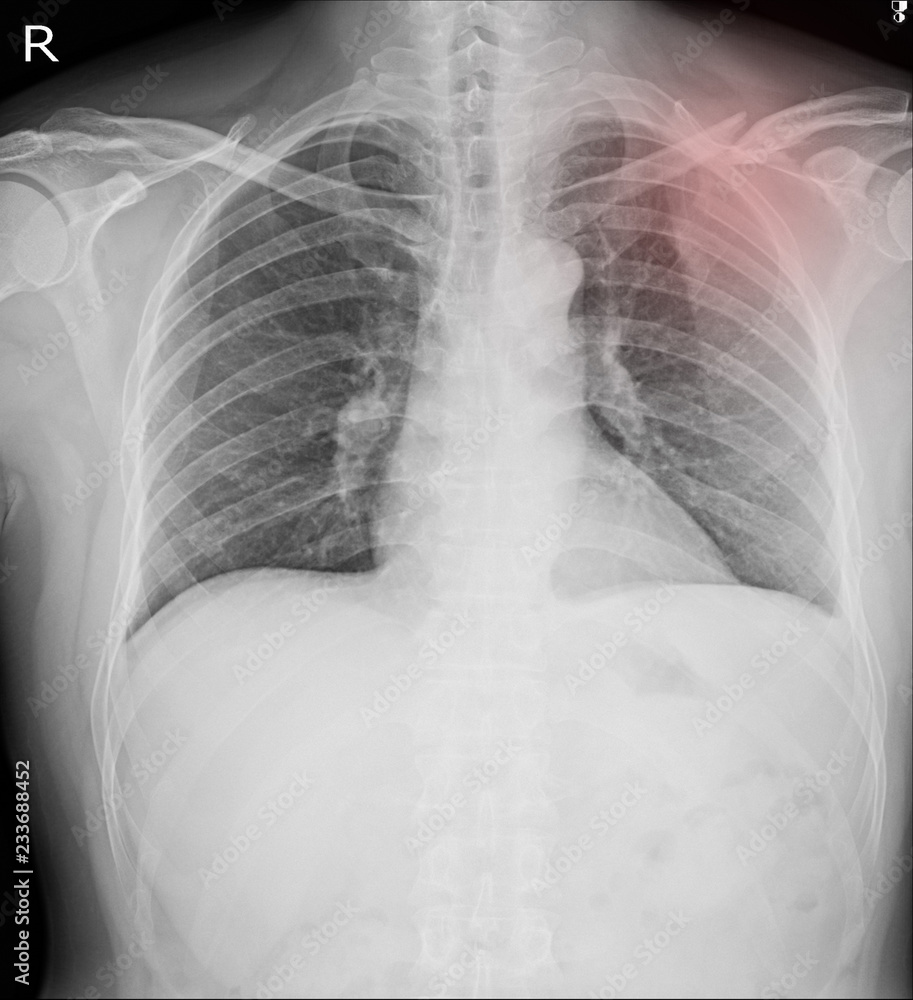 Obraz premium Chest x-ray Fractures left clavicle, anterior 2nd rib, posterior rib 4,5 and lateral aspect of left 6 th rib. Medical images concept.