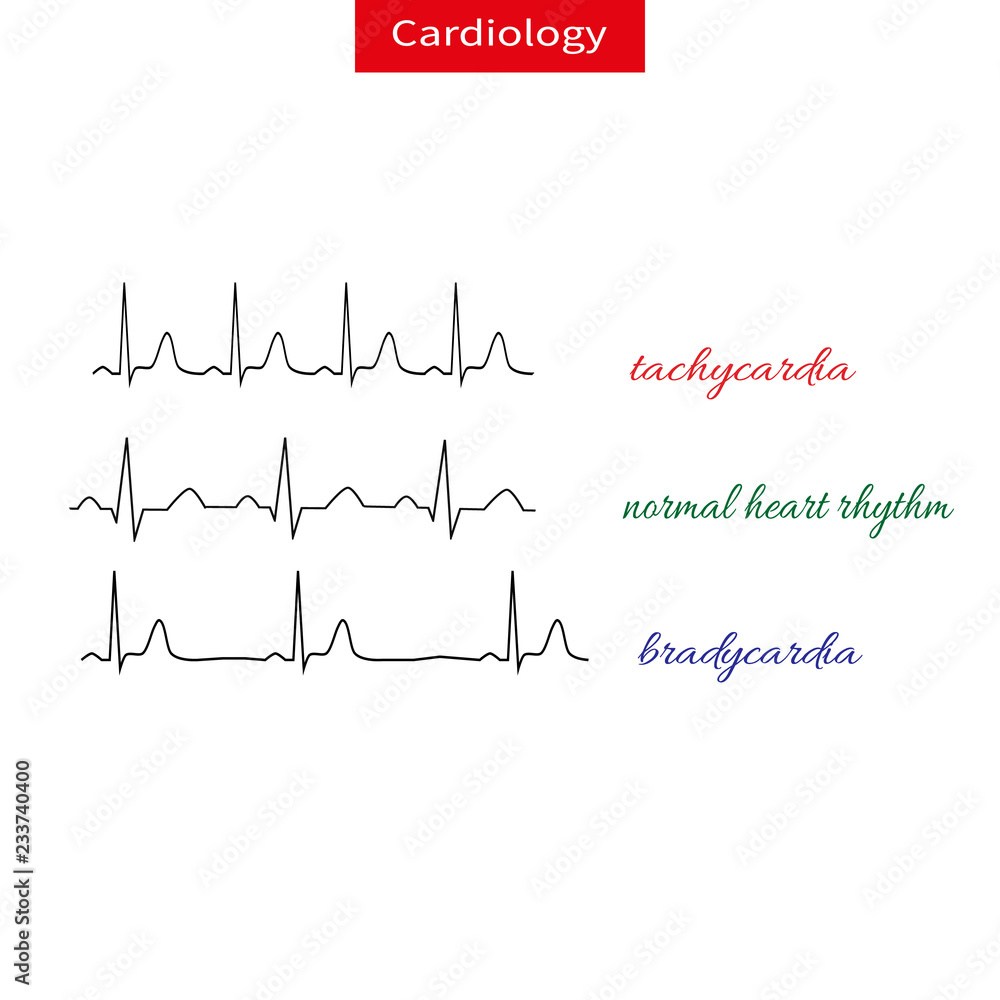 Tachycardia and bradicardia. Difference of heart pulsating, Fast and slow rhythm of heart. Normal heart rhythm.