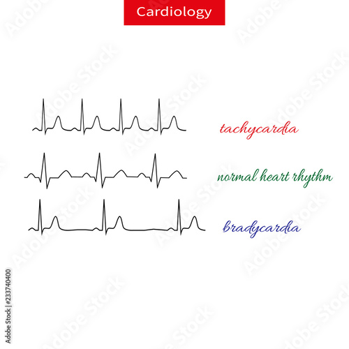 Tachycardia and bradicardia. Difference of heart pulsating, Fast and slow rhythm of heart. Normal heart rhythm.