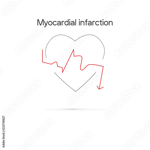 Schematic Electrocardiogram of miocardial infaction.