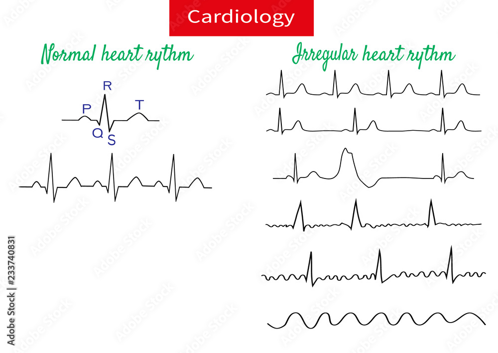 Normal and pathological ecg collection.