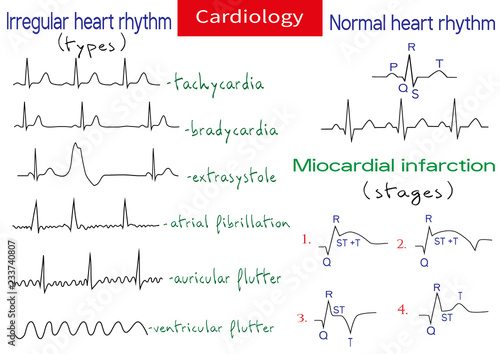 Normal and pathological ecg collection.