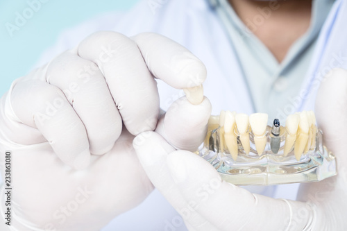 implant and orthodontic model for student to learning teaching model showing teeth. photo