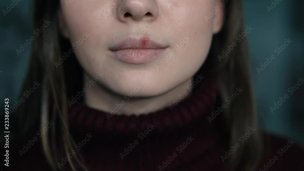 herpes on the lips, part of a woman's face with finger on lips with herpes, beauty concept herpes on the lips, part of a woman's face with finger on lips with herpes, beauty concept
