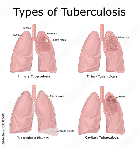 Types of Tuberculosis