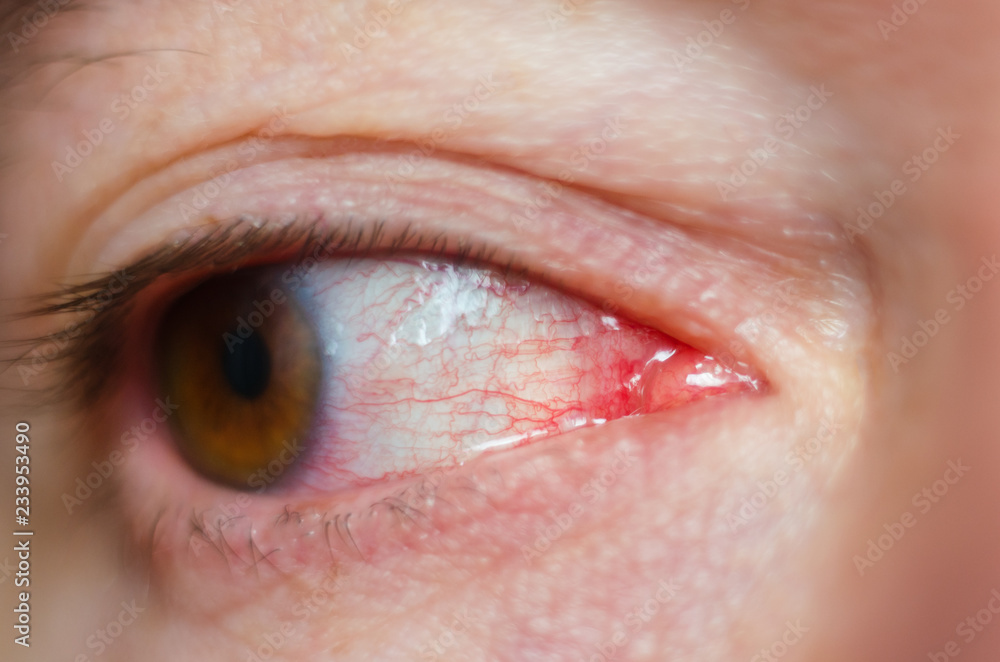 Obraz premium Closeup irritated infected red bloodshot eyes, conjunctivitis