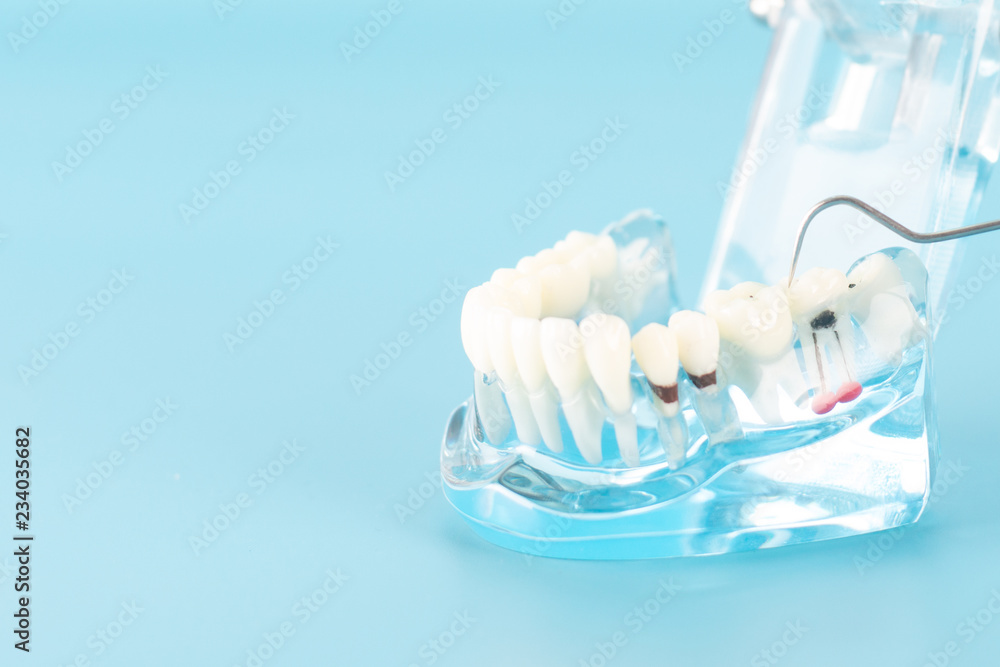 Dental check up with dental model in oral health care concept. Dental check up with dental model in oral health care concept.