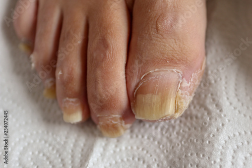Toenail deformity and neglected feet in the elderly