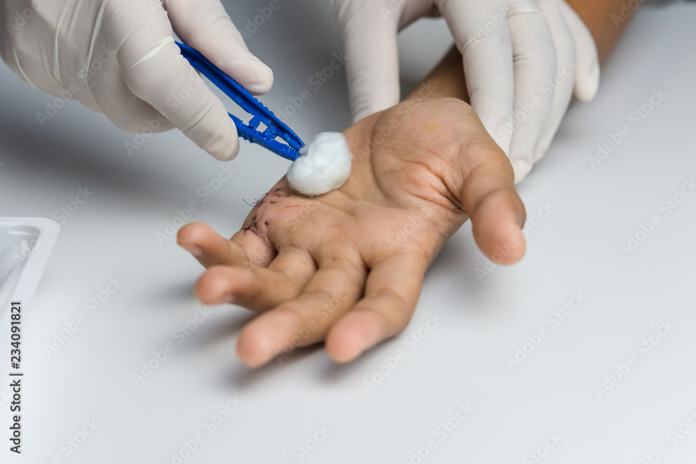 Woman nurse with gloves using cotton wool moistened with alcohol cleaning the wound on the hand of the young man. Woman nurse with gloves using cotton wool moistened with alcohol cleaning the wound on the hand of the young man.