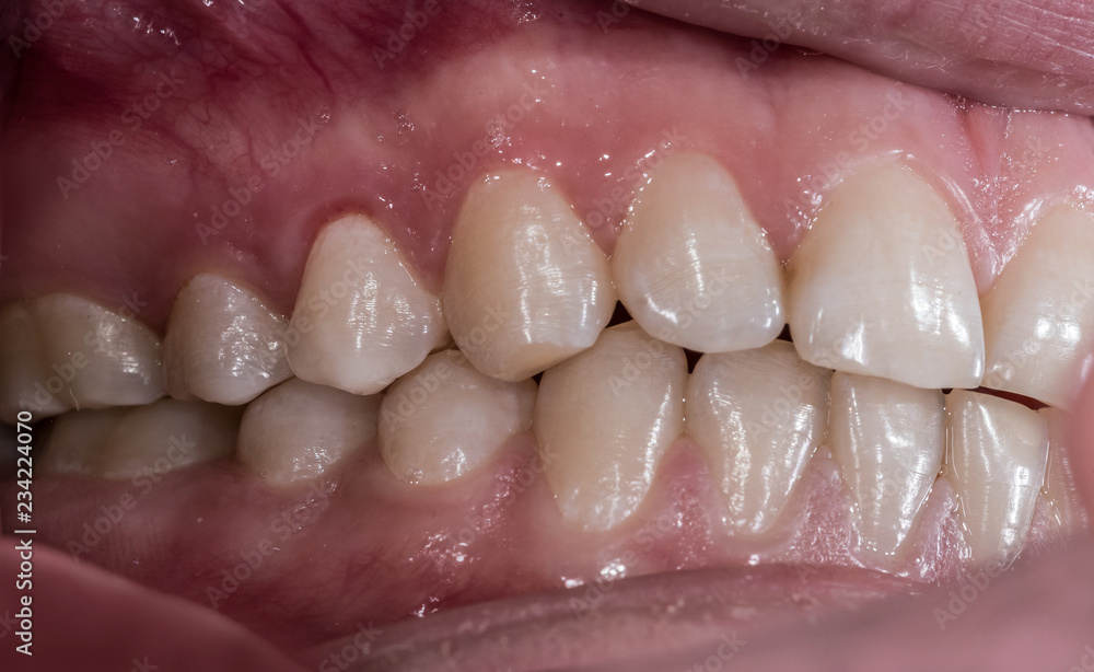 Healthy human teeth with normal occlusion from side view .