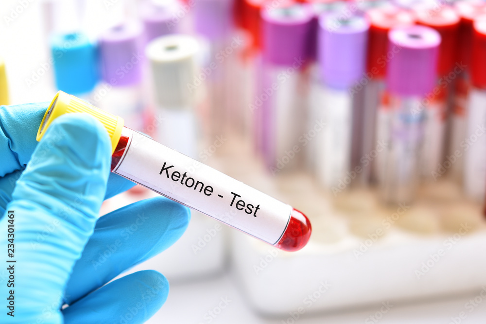 Blood sample tube for ketone test, diagnosis for diabetic ketoacidosis