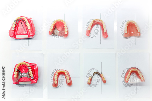 Different types of dental implants