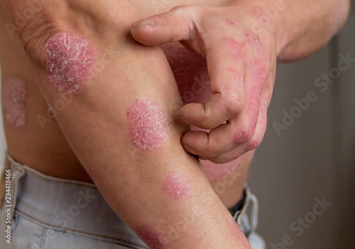 the man on the arm and abdomen spots psoriasis photo