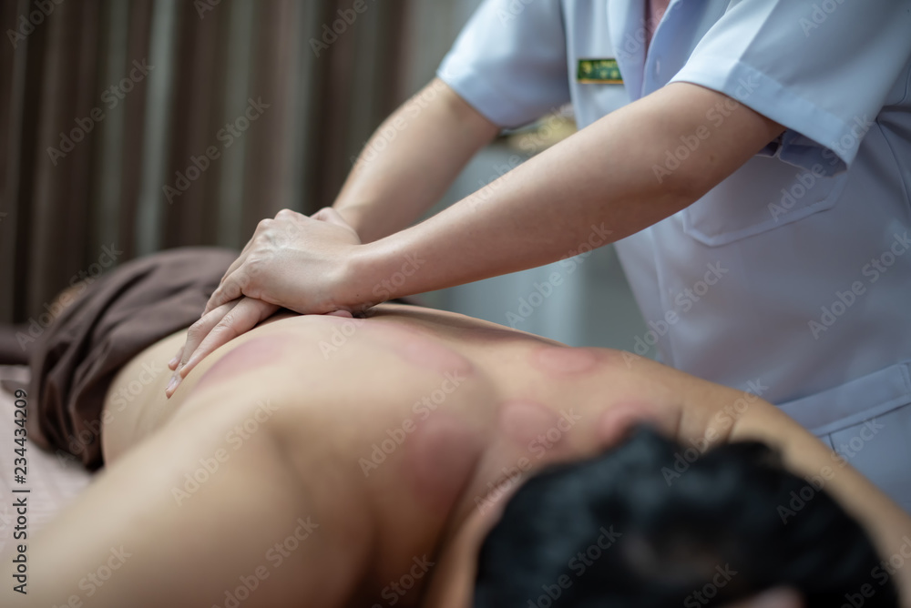 Obraz premium The physiotherapist is checking for abnormalities of the body aftercupping treatment and acupuncture on the back of male patient. Patient is lying down on a bed.