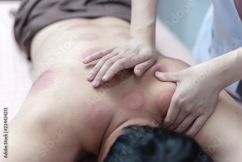 The physiotherapist is checking for abnormalities of the body aftercupping treatment and acupuncture on the back of male patient. Patient is lying down on a bed.