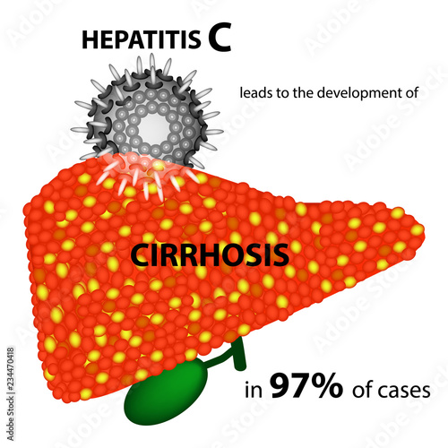 Hepatitis C leads to the development of cirrhosis in 97 percent of cases. Infographics. Vector illustration on isolated background.