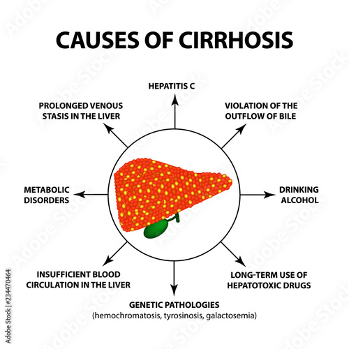 Causes of cirrhosis. Infographics. Vector illustration on isolated background.