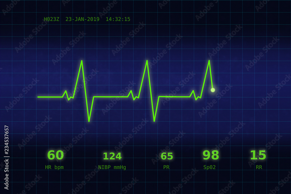 A graph of normal heartbeat on a blue monitor A graph of normal heartbeat on a blue monitor