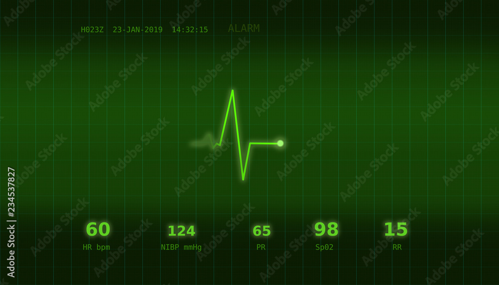 A graph of normal heartbeat on a green monitor