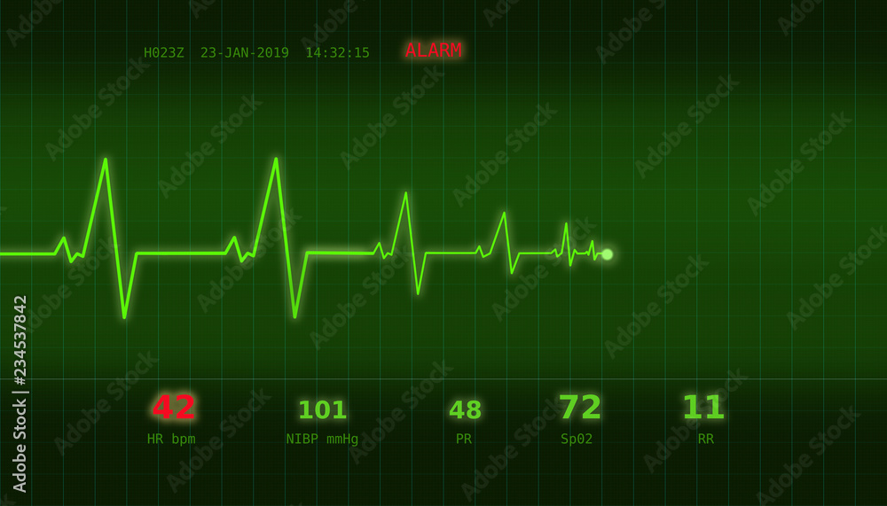 Graph of abnormal heartbeat on a green monitor with an ALARM signal