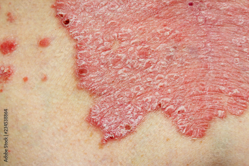 Psoriasis Vulgaris - detail of psoriatic skin disease, an autoimmune skin disorder is typically red, itchy, and scaly, macro with narrow focus photo