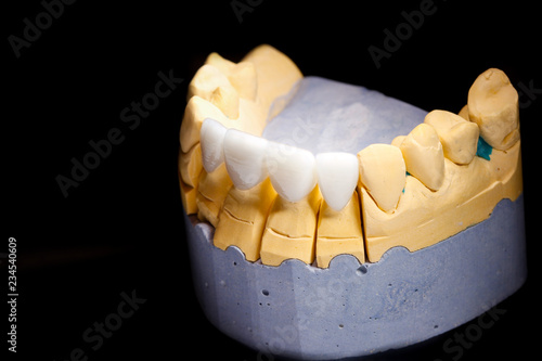 White front teeth veneers on diagnostic model on dark background. Close up.