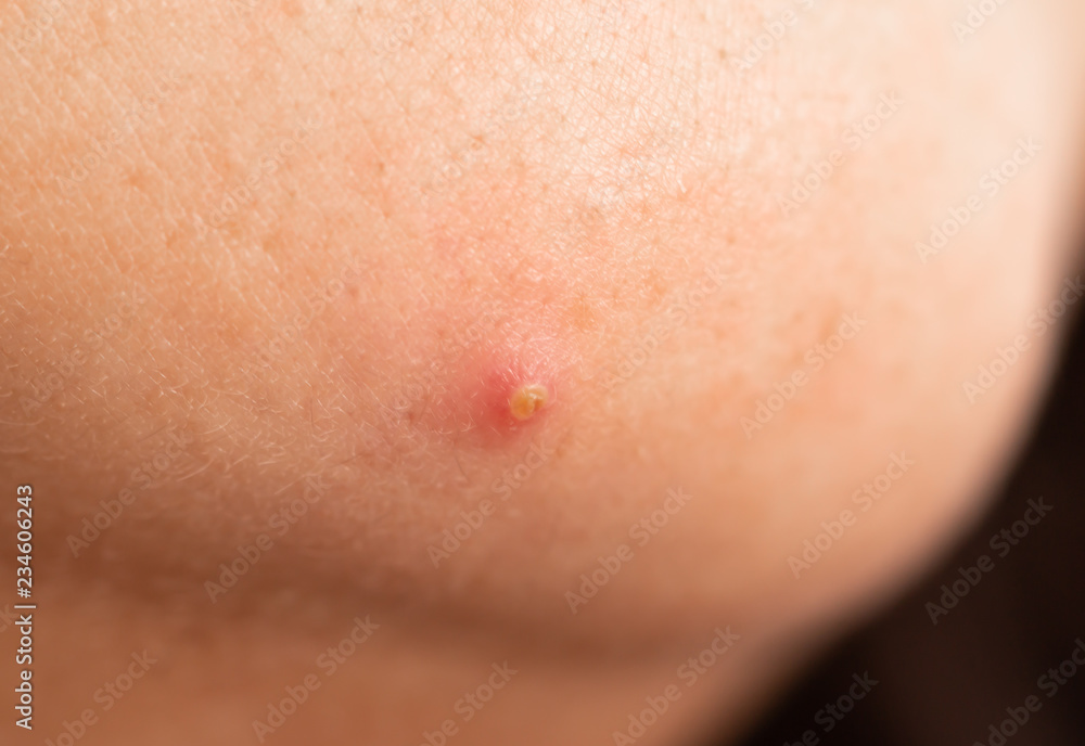 acne on the face acne on the face